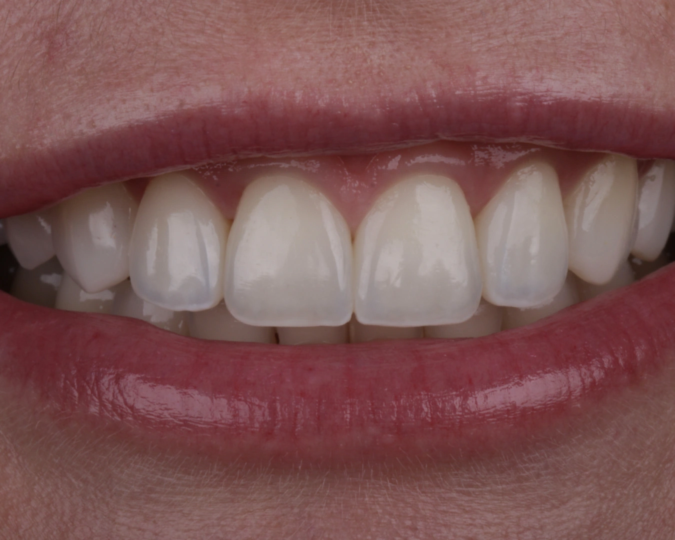Detalle real de anatomía y superficie de dientes anteriores, trabajo de Ana Luiza Libório