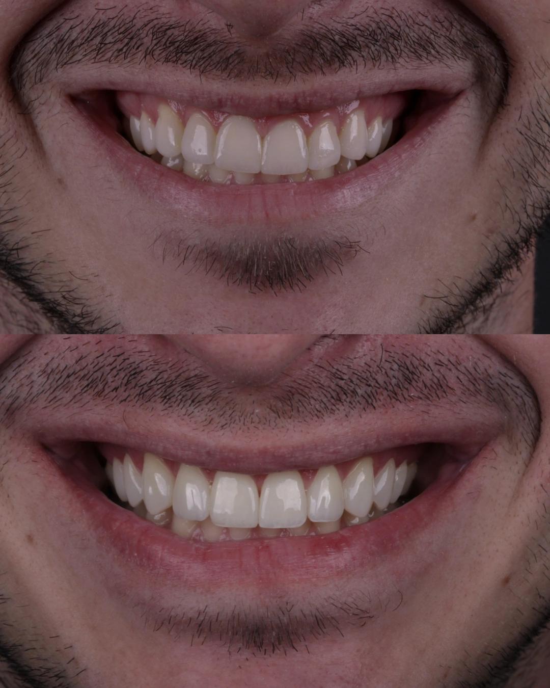 Comparativo clínico original con las fotografías de antes y después, caso 1