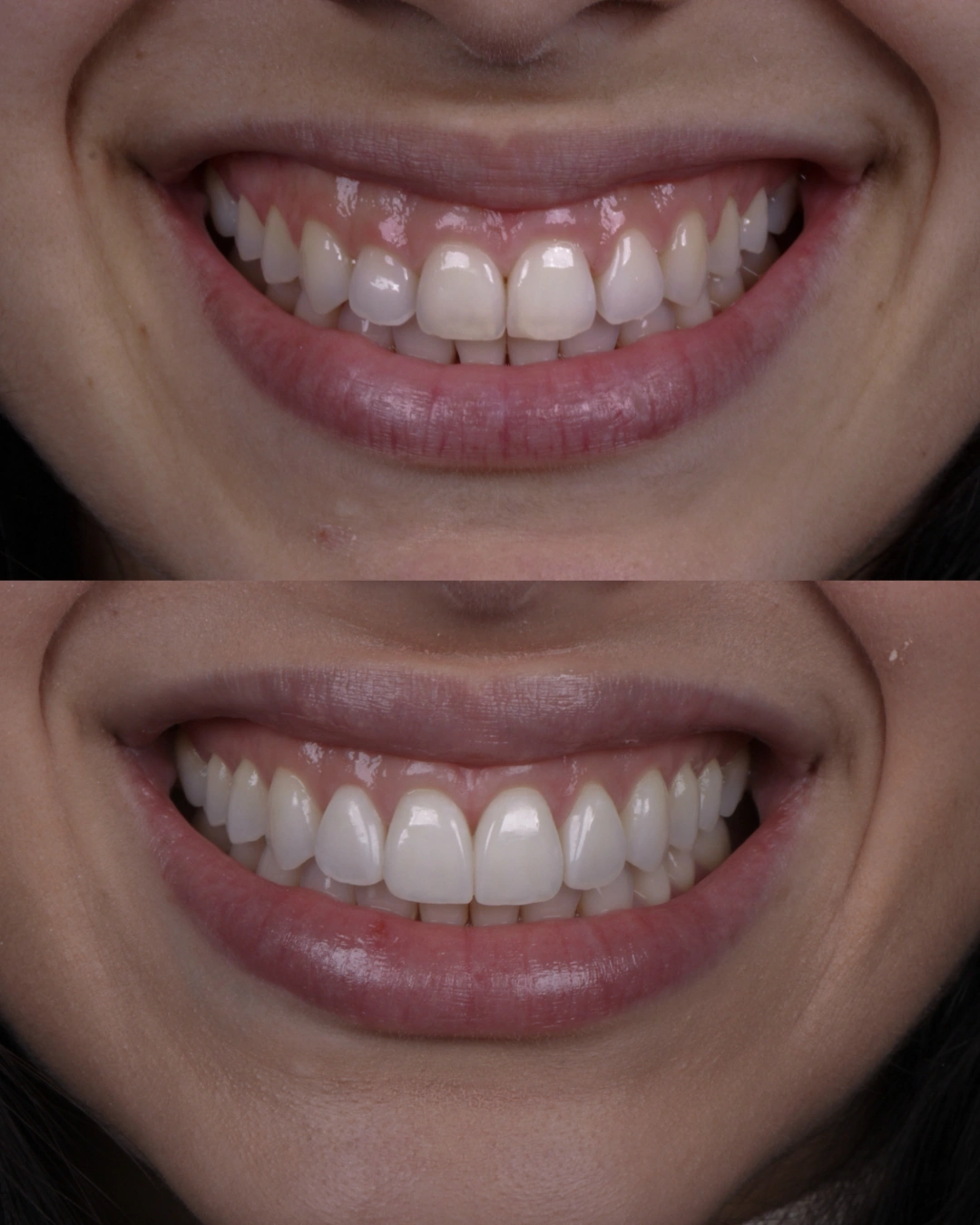 Comparativo clínico original con las fotografías de antes y después, caso 5